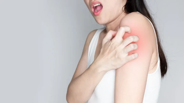 Vì sao bị ghẻ mãi không khỏi? Làm sao điều trị dứt điểm?