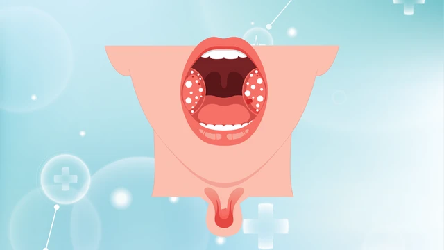 Viêm amidan hốc mủ 1 bên: Dấu hiệu nhận biết, nguyên nhân và cách điều trị