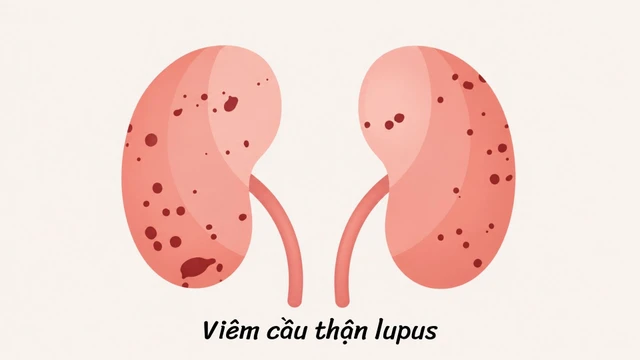 Viêm cầu thận lupus: Triệu chứng, nguyên nhân, chẩn đoán và điều trị