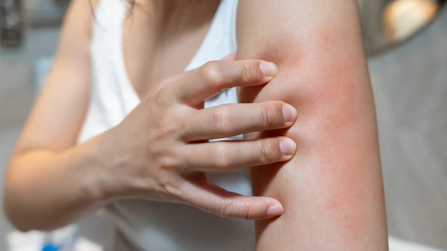 Viêm da tiếp xúc và viêm da cơ địa khác nhau như thế nào?