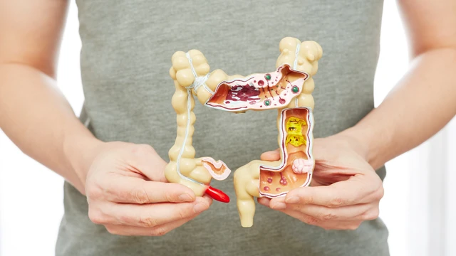 Viêm đại tràng co thắt là gì? Triệu chứng, nguyên nhân, chẩn đoán và phương pháp điều trị