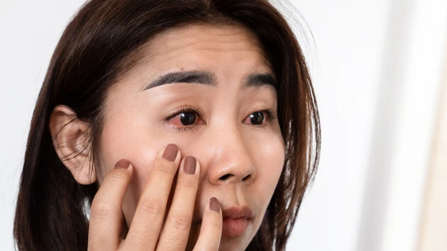 Viêm kết giác mạc: Nguy cơ tiềm ẩn từ những thói quen hàng ngày