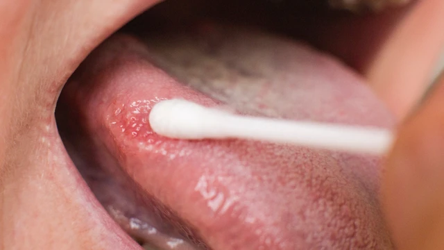 Viêm lưỡi: Triệu chứng, nguyên nhân, cách điều trị và phòng ngừa