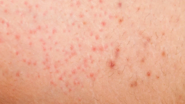Viêm nang lông: Triệu chứng, nguyên nhân, chẩn đoán và điều trị
