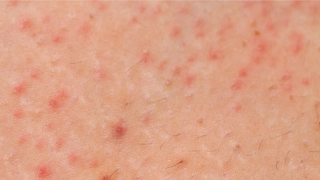Viêm nang lông Malassezia: Nguyên nhân, triệu chứng và cách điều trị