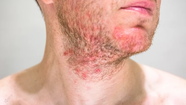 Viêm nang lông ở mặt​: Dấu hiệu và cách phòng ngừa