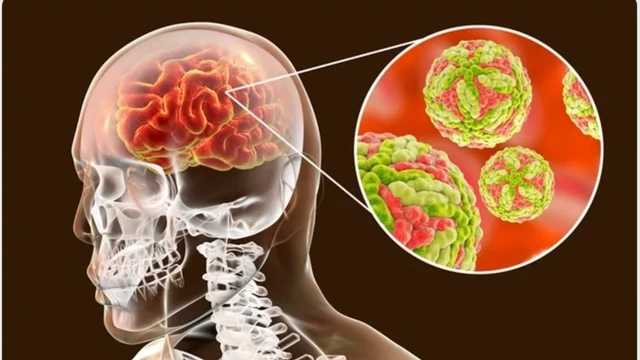 Viêm não Nhật Bản có chữa được không? Tiên lượng và cách điều trị