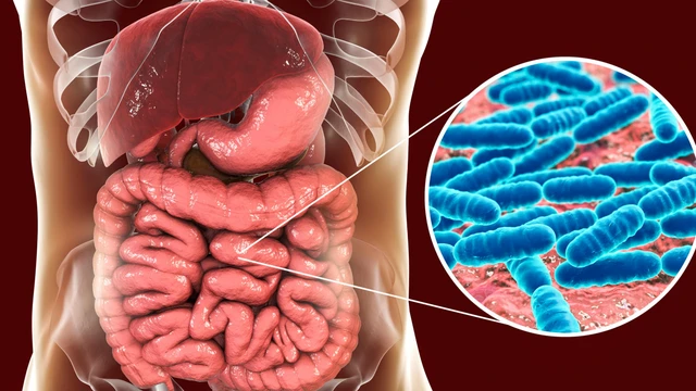 Viêm ruột do Giardia: Nguyên nhân, triệu chứng và cách điều trị