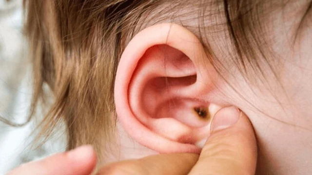 Viêm tai giữa có mủ bao lâu thì khỏi? Điều trị bệnh như thế nào?