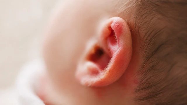 Viêm tai ngoài ở trẻ sơ sinh là gì? Nguyên nhân và dấu hiệu nhận biết