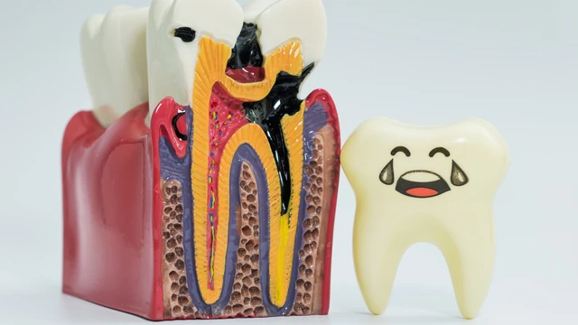 Viêm tủy răng kiêng ăn gì​? Mối liên hệ giữa chế độ ăn uống và viêm tủy răng