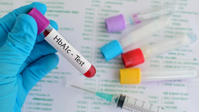 Xét nghiệm HbA1c cần nhịn ăn không? Cách chuẩn bị và đọc kết quả