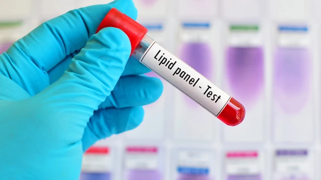 Xét nghiệm lipid máu cho bà bầu: Khi nào cần thực hiện?