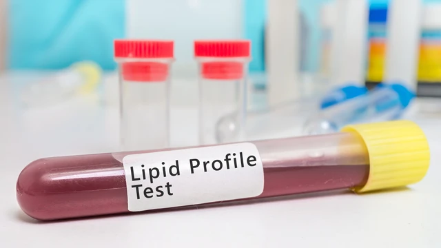 Xét nghiệm lipid máu là gì? Khi nào nên thực hiện?