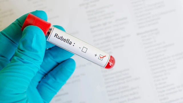 Xét nghiệm Rubella để làm gì? Các bước thực hiện