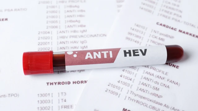 Xét nghiệm viêm gan E: Những điều cần biết trước khi thực hiện