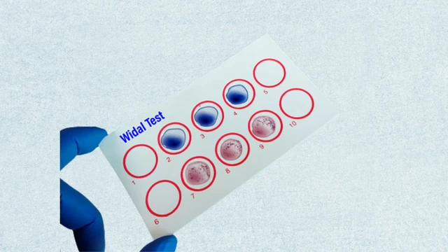 Xét nghiệm Widal là gì? Mục đích và quy trình thực hiện xét nghiệm Widal
