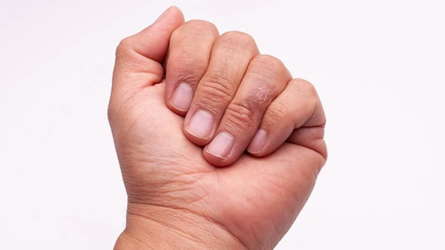 Xơ cứng bì khu trú: Nguyên nhân, triệu chứng và cách điều trị