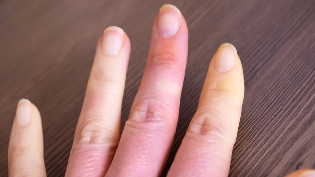 Xơ cứng bì toàn thể: Nguyên nhân, triệu chứng và cách điều trị