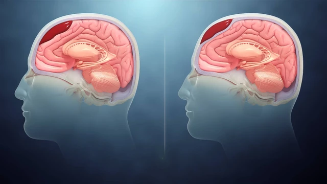 Xuất huyết não có hồi phục được không và các yếu tố ảnh hưởng?
