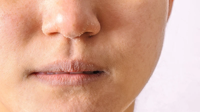 Bị khô rát viền môi là tình trạng vùng da xung quanh môi bị khô, bong tróc, nứt nẻ hoặc cảm giác rát, châm chích