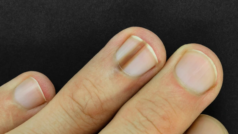 Nhiều người thường hỏi móng tay bị thâm đen là bệnh gì?
