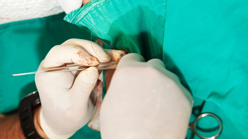 Cắt bao quy đầu có đau không là câu hỏi được nhiều bạn nam đặt ra
