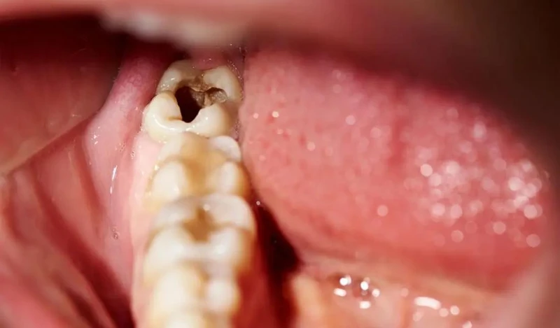 Sâu răng tạo ổ viêm khiến vi khuẩn lan rộng và gây sưng hạch dưới hàm