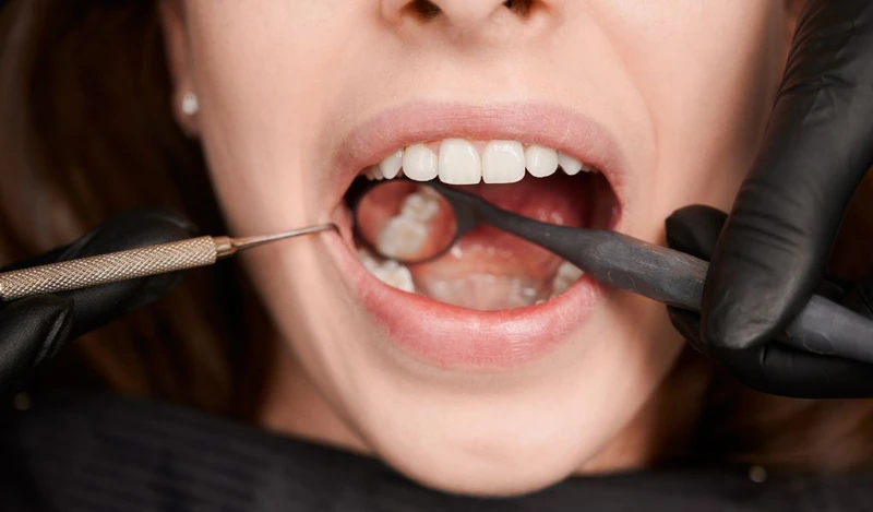 Khám nha khoa kịp thời giúp phát hiện sớm nguyên nhân gây đau răng nổi hạch dưới hàm