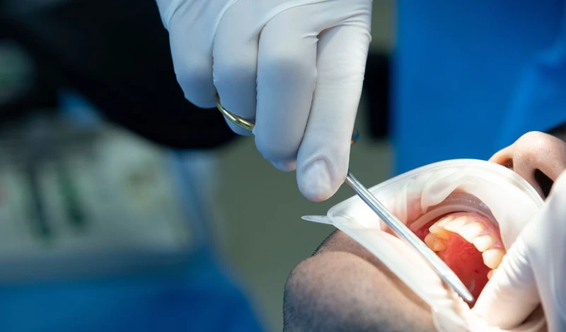 Điều trị đau răng kèm sưng hạch cần xử lý ổ viêm và lựa chọn phương pháp phù hợp theo từng mức độ