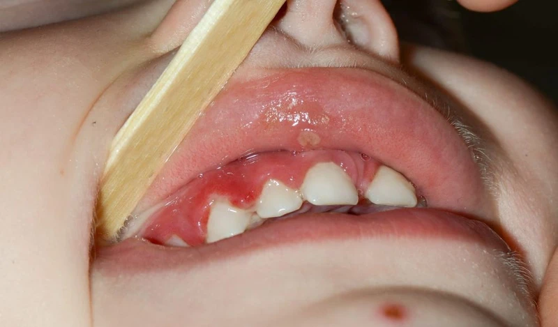 Nướu bị tổn thương có thể khiến trẻ bị hôi miệng chảy máu chân răng