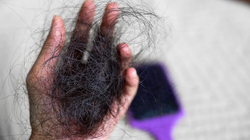 Rụng tóc nhiều ở tuổi dậy thì có đáng lo không?