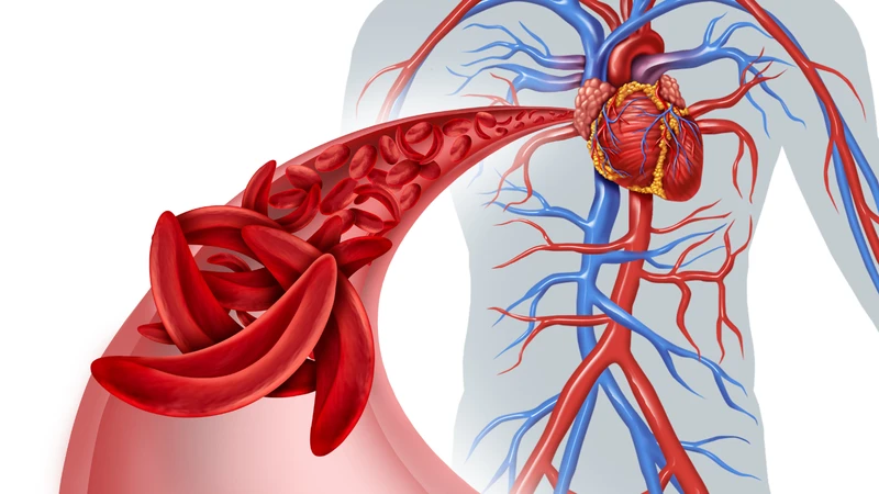 Hồng cầu hình lưỡi liềm dễ kết dính và tăng nguy cơ tắc mạch