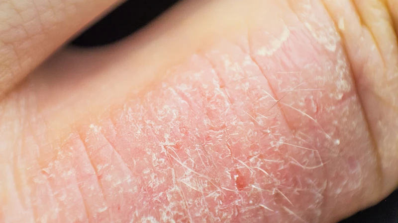 Giai đoạn mạn tính, da trở nên dày, khô ráp, lichen hóa rõ và có thể xuất hiện các vết nứt sâu gây đau rát