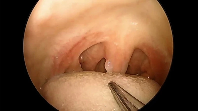 U nhú lưỡi gà là gì? Nguyên nhân, triệu chứng, điều trị và cách phòng ngừa u nhú lưỡi gà 2.png