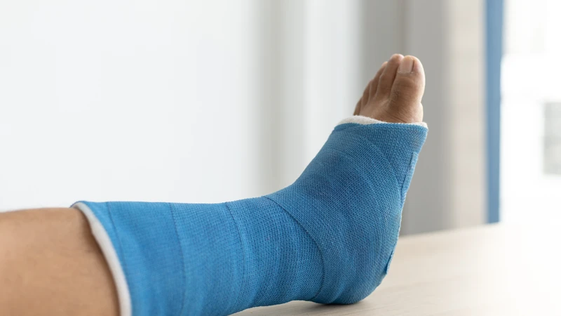 Bó bột là phương pháp điều trị bảo tồn được áp dụng trong các trường hợp gãy xương không di lệch