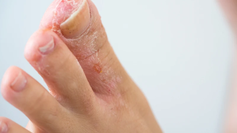 Nấm kẽ chân do nấm Trichophyton rubrum gây ra, thường khiến da bong tróc, đổi màu, nứt nẻ đau rát và có mùi khó chịu