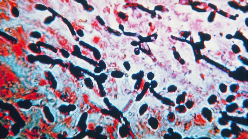 Nhiễm nấm Candida âm đạo có thể làm tăng nguy cơ viêm cổ tử cung