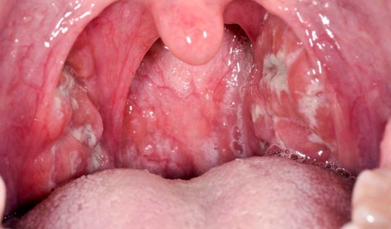 Viêm amidan do liên cầu khuẩn với những nốt mủ trắng