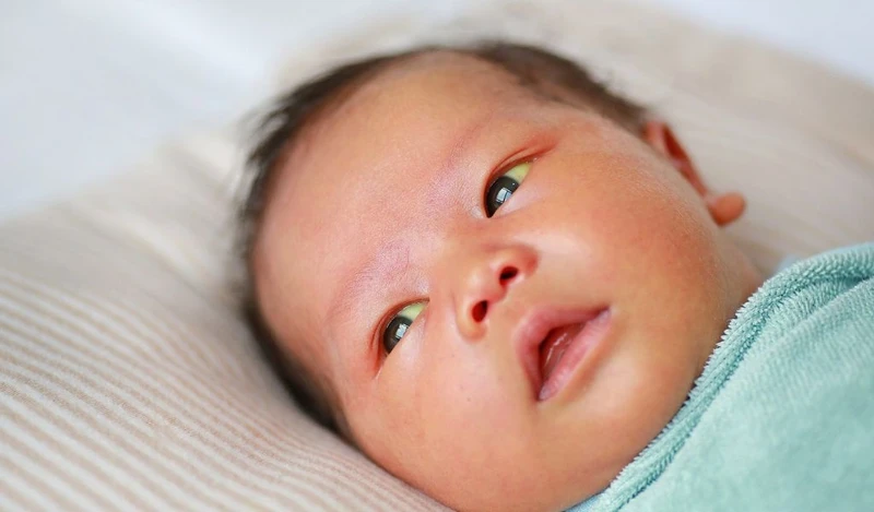Vàng da ở trẻ sơ sinh kéo dài trên 14 ngày có thể là dấu hiệu suy giáp bẩm sinh cần được kiểm tra sớm