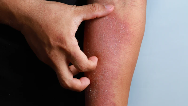 Hạn chế gãi tại vùng da bị viêm để tránh gây trầy xước