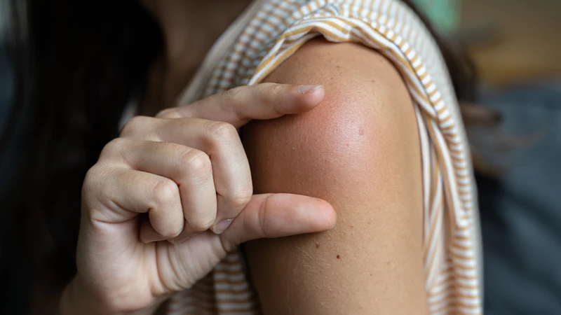 Có thể bị sưng, đỏ, đau tại vị trị tiêm và triệu chứng sẽ giảm sau 1 - 2 ngày