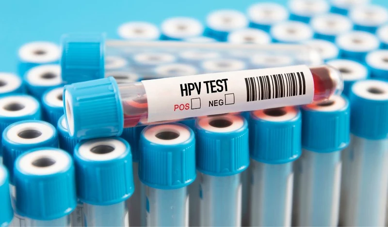 Nhiễm HPV là nguyên nhân phổ biến khiến tế bào cổ tử cung biến đổi và xuất hiện kết quả ASCUS trong xét nghiệm