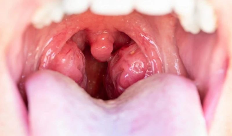 Hình ảnh minh họa amidan sưng đỏ, đau rát khi bị nhiễm trùng
