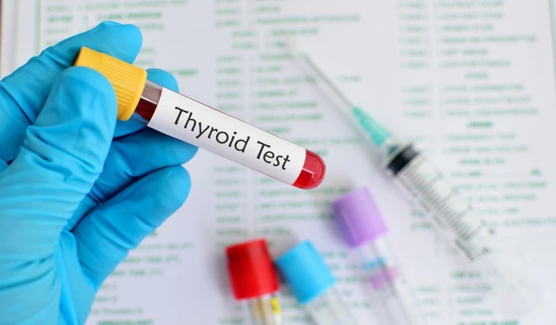 Xét nghiệm suy giáp bẩm sinh bằng cách xét nghiệm các hormone tuyến giáp