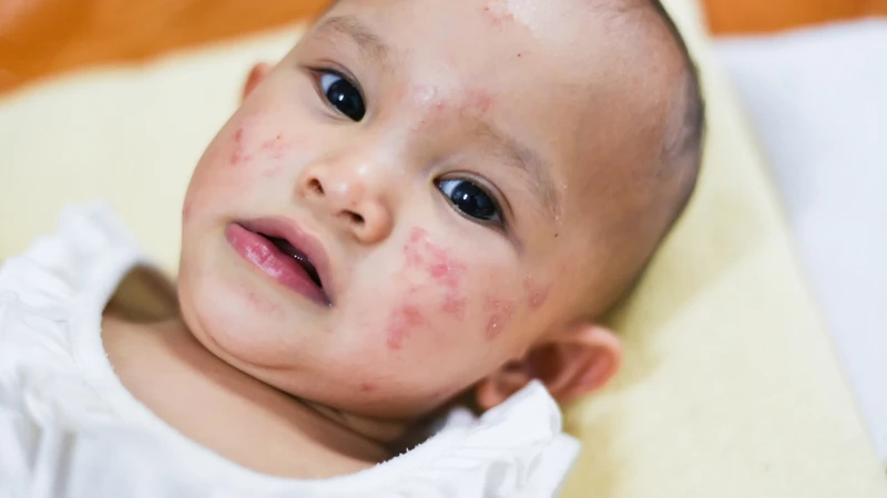 Hệ miễn dịch phản ứng quá mức với dị nguyên như bụi, phấn hoa có thể gây bùng phát viêm da ở trẻ