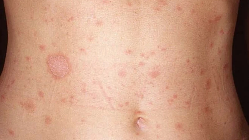 4 giai đoạn bệnh giang mai: Nhận biết và hướng điều trị phù hợp 2