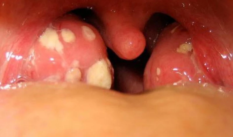 Amidan viêm kéo dài khiến nhiều người băn khoăn rằng cắt amidan có đau không?
