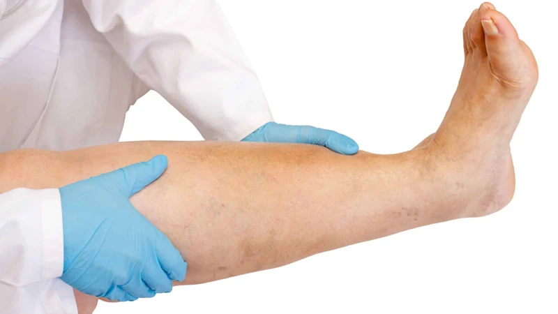 Phù chân: Nguyên nhân, triệu chứng, chẩn đoán, điều trị và phòng ngừa 5.png