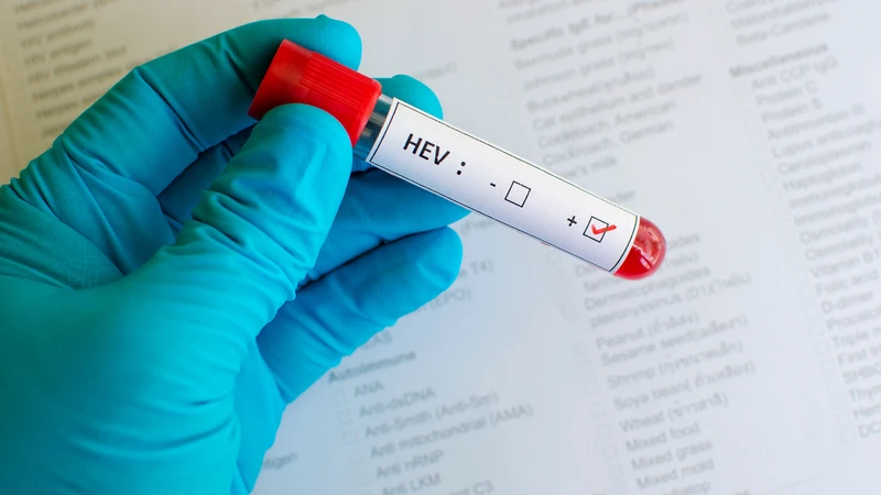 Viêm gan E là bệnh do virus gây ra và có thể liên quan đến việc tiêu thụ thịt hoặc gan heo chưa được nấu chín kỹ